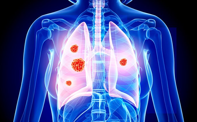 IMMUNOTHERAPY IN LUNG CANCER
